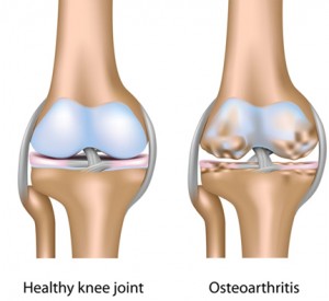 Osteoarthritis