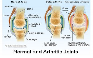 Types of Arthritis